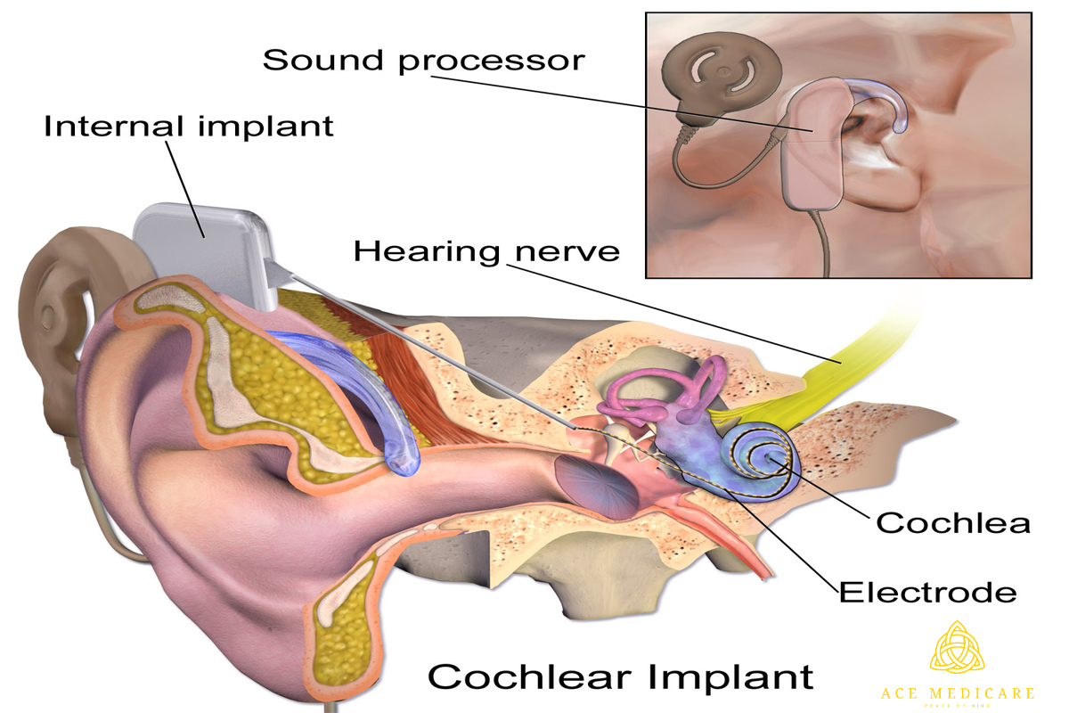 The Future of Middle Ear Transplant Surgery: Exploring Innovative Technologies